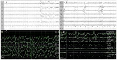 Pre- and Post-surgical Poor Seizure Control as Hallmark of Malignant Progression in Patients With Glioma?